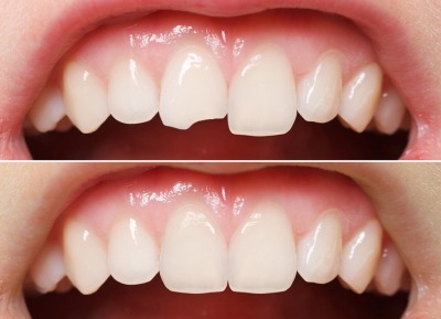 Dental Estetik Dolgu