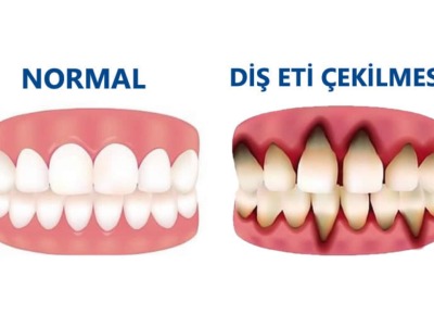 Diş Eti Tedavisi