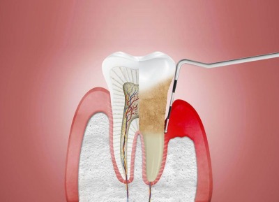 Periodontal Küretaj Tedavisi